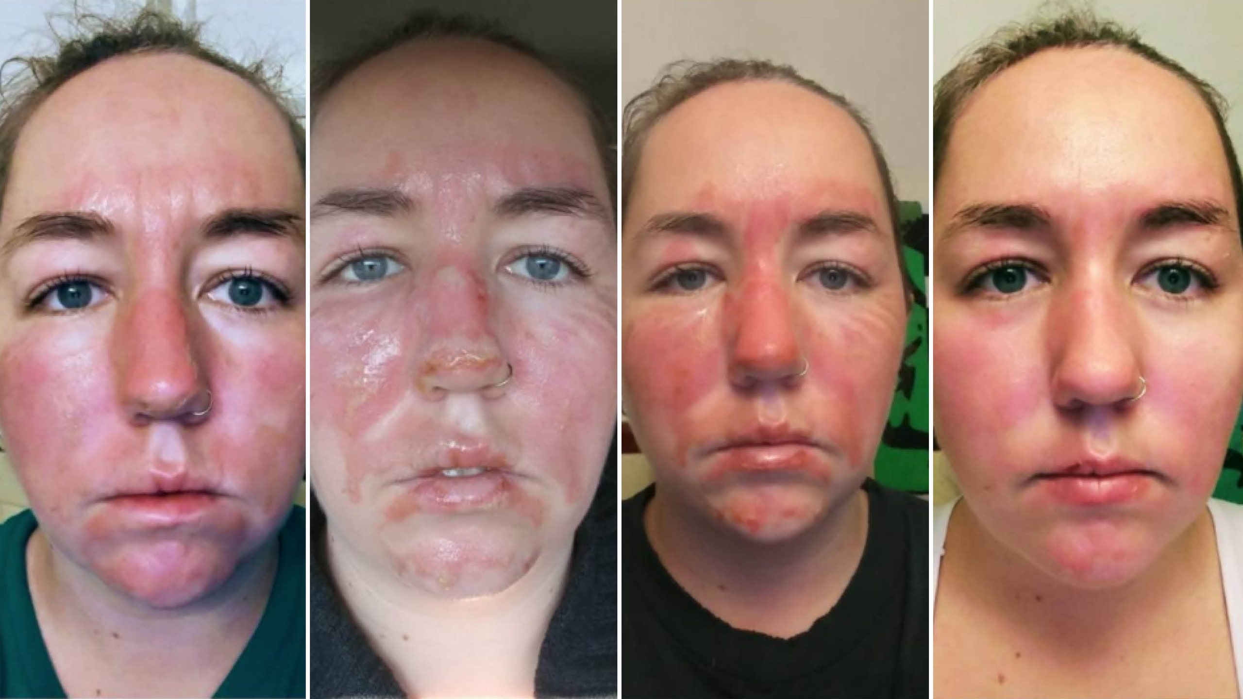 Before and after image facial burns