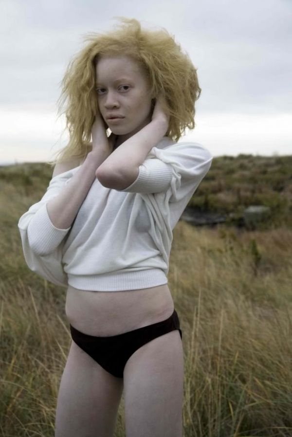 Asian girl albinos xxx