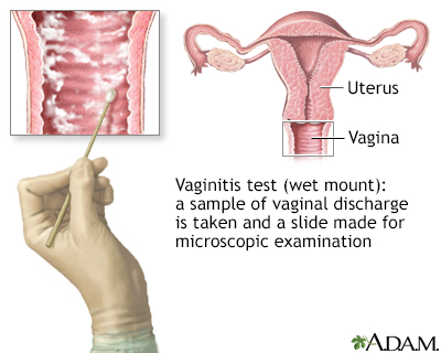 How to obtain vaginal swab for vaginitis