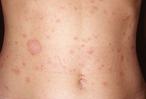 Common skin rashes in adults