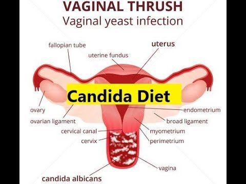 Infection vaginal diet yeast