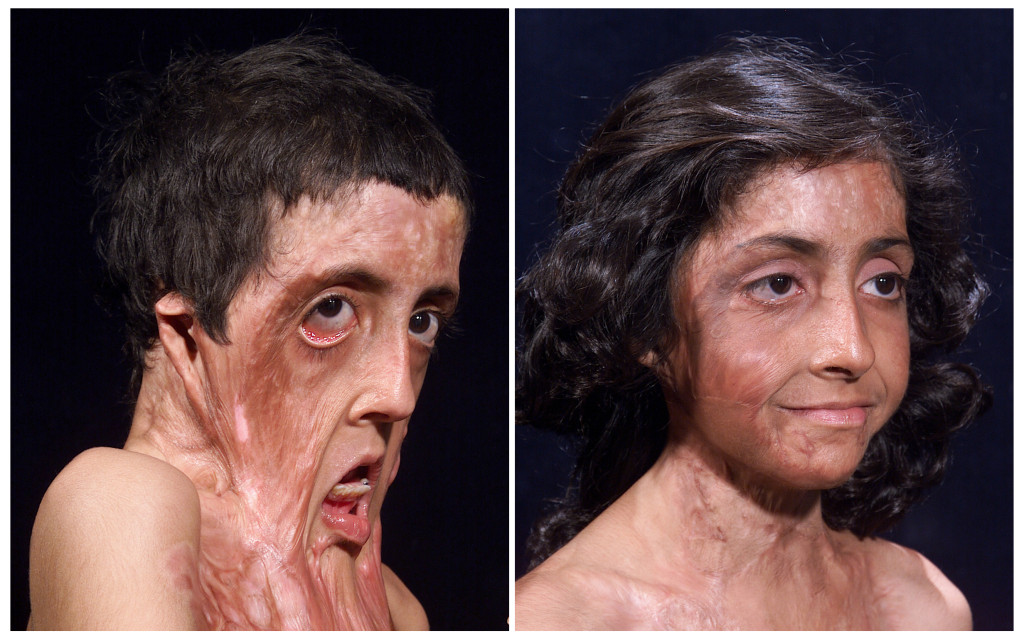 Before and after image facial burns