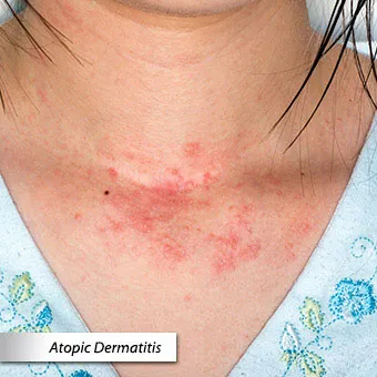 Common skin rashes in adults