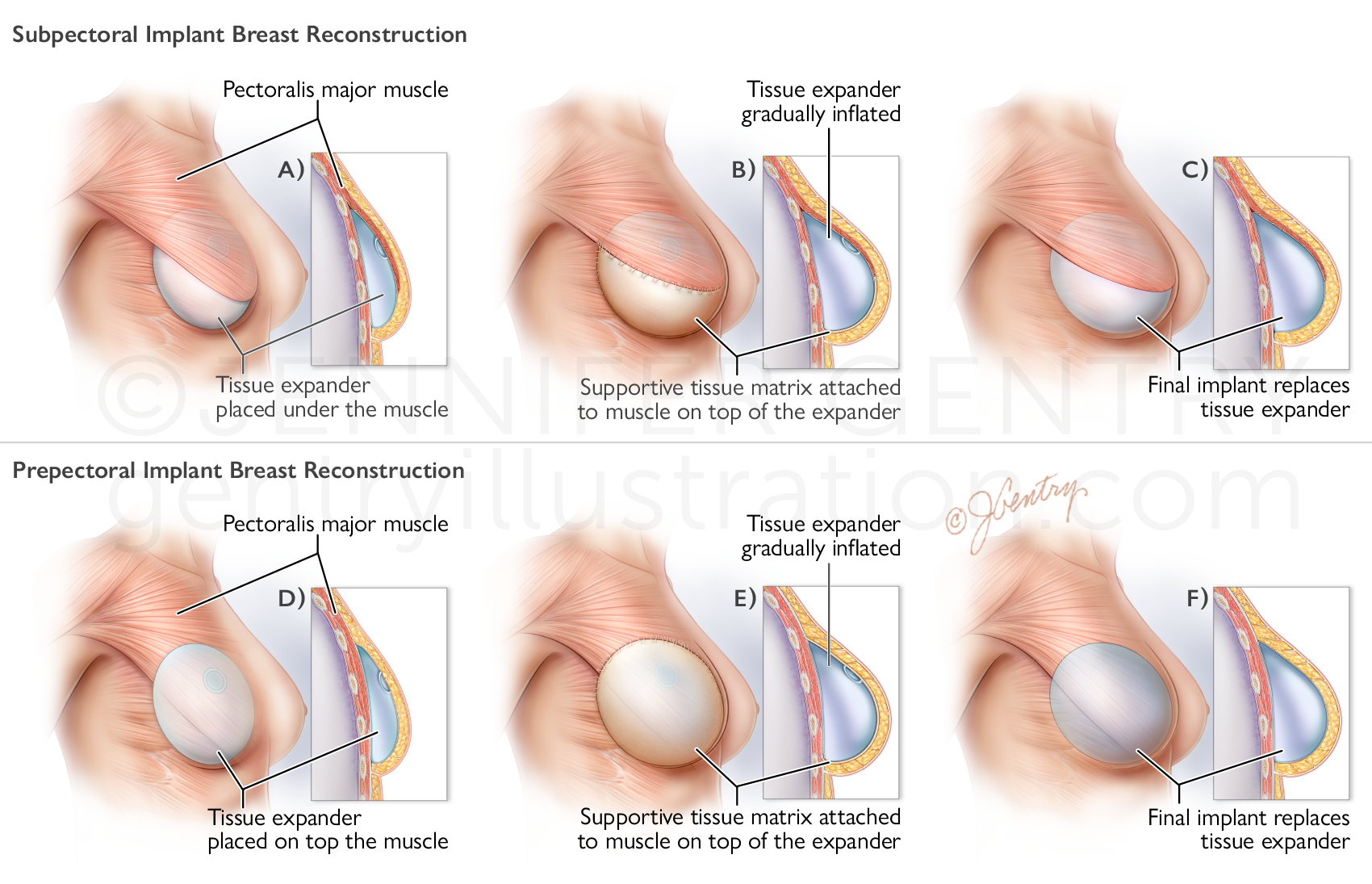 Breast reconstruction tissue expanders